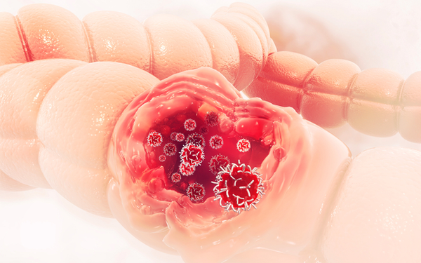 Nếu phân có kích thước mỏng như một chiếc bút chì hoặc có hình lá lúa do phải đi qua khối u thì cần đến bệnh viện khám và kiểm tra ngay. Ảnh: cafebizcdn.