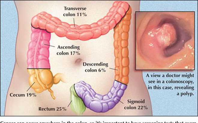 Người bị ung thư đại trực tràng bị rối loạn tiêu hóa, đi ngoài nhiều lần trong ngày, cùng với đó là tình trạng chán ăn, khó tiêu, đầy trướng bụng trên vùng rốn, ăn không ngon. Ảnh: sohacdn.
