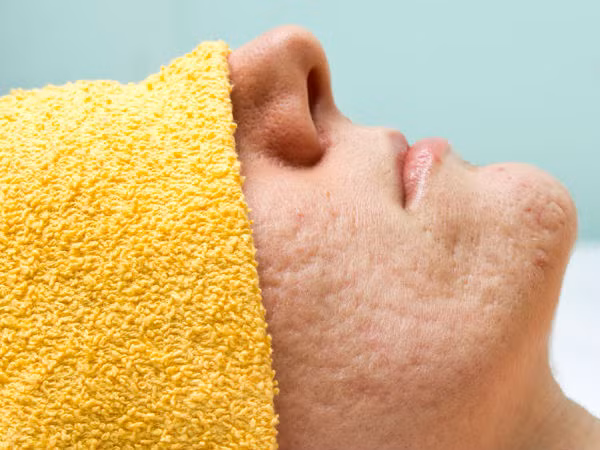 Một trong những nguyên nhân khiến lỗ chân lông to đó chính là do bạn sở hữu một làn da dầu, các tuyến bã nhờn trên da hoạt động quá mức.