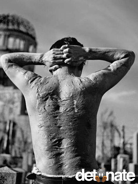 Hình ảnh ám ảnh một nạn nhân với cơ thể toàn vết bỏng do tác động của sự kiện Mỹ ném bom hạt nhân xuống thành phố Hiroshima, Nhật Bản những ngày đầu tháng 8/1945.