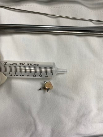 Súc miệng, răng giả chui vào phế quản Suc mieng, rang gia chui vao phe quan