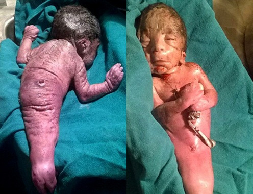 Thuong tam em be mac hoi chung nang tien ca hiem gap