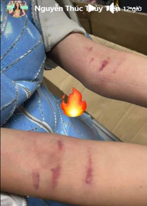 Sau đêm thi, Thùy Tiên hé lộ hình ảnh hai cánh tay bị thương. Người đẹp chia sẻ trên Ngôi sao, do phần tay áo bị chật nên khi vận động trong hậu trường, cô bị tụ máu. Khi lên trình diễn, Thùy Tiên quyết định bỏ bớt đôi găng tay boxing để dễ dàng vận động. Người đẹp hy vọng vết bầm kịp tan trước khi bán kết diễn ra vào tối ngày 2/12. Ảnh chụp màn hình