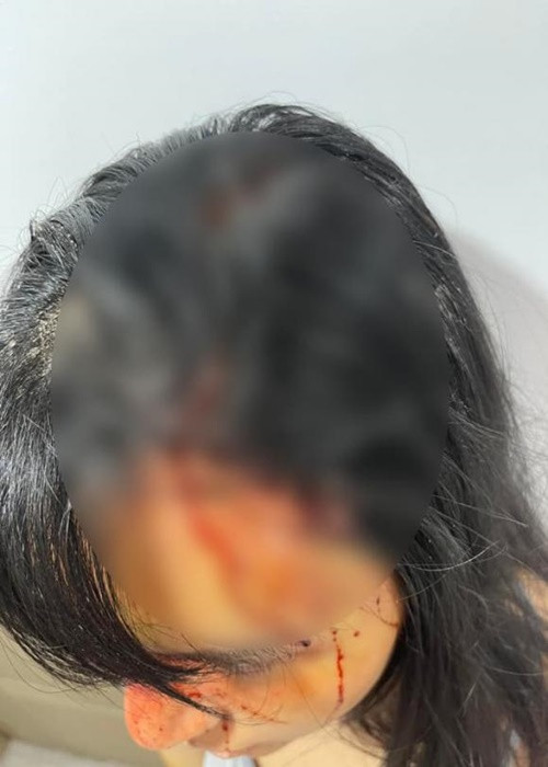 Khả Trang bị rách đầu chảy máu, gãy mũi. Ảnh: Công lý và xã hội