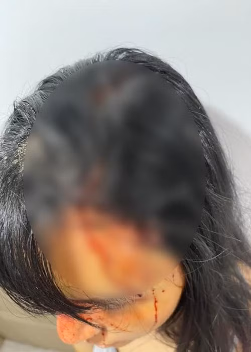 Khả Trang bị rách đầu chảy máu, gãy mũi. Ảnh: Công lý và xã hội