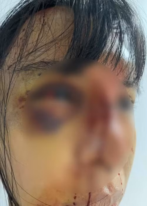 Hai mắt của nữ người mẫu tím bầm. Ảnh: Công lý và xã hội