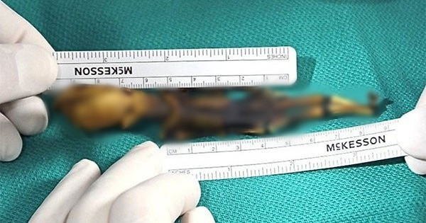 Tuy nhiên, bộ xương "tí hon" này được đặt tên là Ata và có một số đặc điểm bất thường là: chỉ có 10 xương sườn thay vì 12 chiếc, hốc mắt lớn, hộp sọ dài.