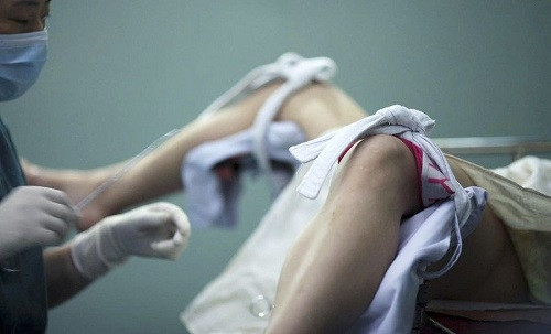 Thủng tủ cung, thai nhi chui vào ỏ bụng do pha thai