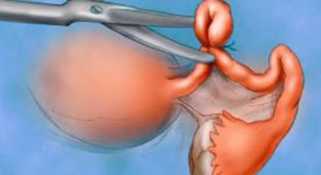 Thủ thuật cắt bỏ buồng trứng và ống dẫn trứng thường được các bác sĩ chỉ định cho bệnh nhân ung thư tử cung, ung thư buồng trứng, hoặc được áp dụng như một biện pháp ngăn ngừa ung thư vú, ung thư buồng trứng… ở những người có nguy cơ cao, nhóm có sự biến đổi ở gen BRCA1 và BRCA2 như Angelina Jolie.