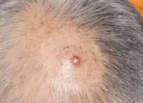 Thay mun tren da dau, di kham phat hien ung thu da day