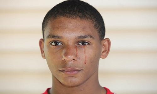 Y học thế giới ghi nhận một số người khóc ra máu vô cùng kỳ lạ và hiếm gặp. Trong số này, nổi tiếng là trường hợp của cậu bé Calvino Inman, 15 tuổi, đến từ bang Tennessee, Mỹ.