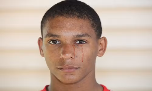 Y học thế giới ghi nhận một số người khóc ra máu vô cùng kỳ lạ và hiếm gặp. Trong số này, nổi tiếng là trường hợp của cậu bé Calvino Inman, 15 tuổi, đến từ bang Tennessee, Mỹ.