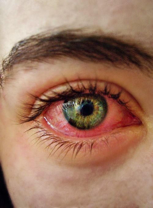 Theo đó, nước mắt của một người bị nhuộm máu một phần hoặc hoàn toàn.