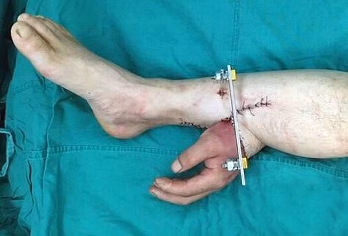 Các bác sỹ Trung Quốc vừa thực hiện một ca phẫu thuật đặc biệt để cứu bàn tay của một bệnh nhân bằng cách gắn nó vào chân của chính bệnh nhân đó trong khi chờ phẫu thuật. Đó là nguồn gốc của cảnh tay mọc từ chân như trong hình.
