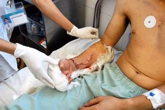 Hiện tại, anh Zhou đã có thể cử động nhẹ các ngón tay nhưng anh vẫn cần phải tập luyện nhiều trước khi sử dụng lại được bàn tay như trước đây. 