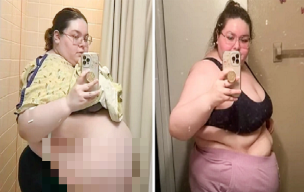 Tuong beo phi, co gai tre lang nguoi phat hien khoi u 