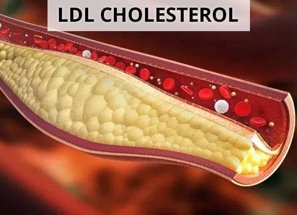 Cholesterol LDL được đánh giá là xấu do tích tụ nhiều ở động mạch, làm hẹp động mạch, cản trở tuần hoàn máu. Theo thời gian, cholesterol LDL tích tụ dễ dẫn đến các bệnh tim mạch, mạch máu não.