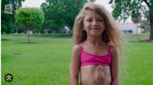 Trải qua nhiều thử thách để sống, giờ đây thay vì nơm nớp lo lắng vì bệnh tình của con gái, Dari Barun tự hào chia sẻ những hình ảnh của cô bé trên trang Instagram. Những bức ảnh cho thấy Virsaviya luôn lạc quan bất chấp trái tim lộ rõ dưới làn da mỏng. Dari hi vọng truyền năng lượng tích cực của con gái đến mọi người. (Ảnh: Thesun)