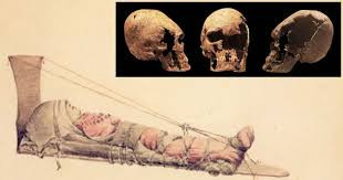 Căn bệnh nguy hiểm này không để lại bất cứ bằng chứng nào trên xương.