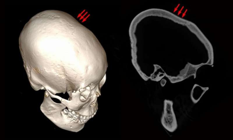 Người xưa sử dụng một số công cụ khác nhau để làm biến dạng hộp sọ kể từ khi dưới 10 tuổi.