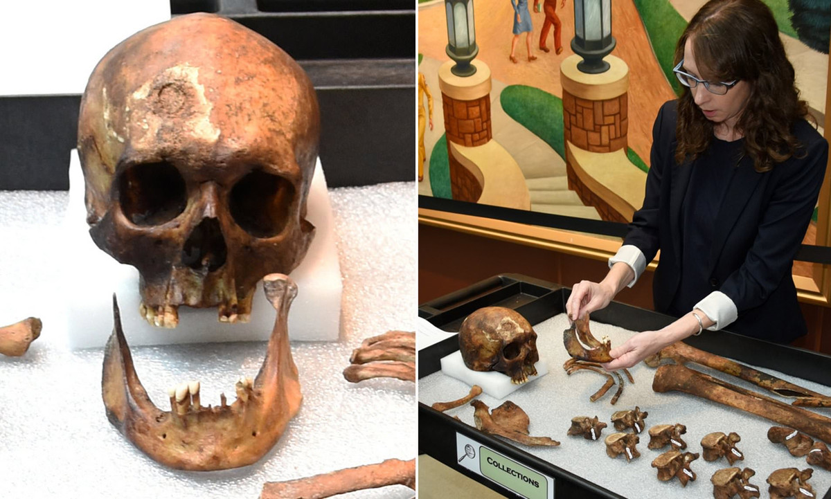 Người đàn ông sống vào thế kỷ 19 này mắc căn bệnh lao và viêm khớp.