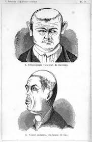 Cụ thể, bác sĩ Lombroso nhận ra sự tương đồng về khuôn mặt và chiều dài bất thường các ngón tay giữa những tên tội phạm.