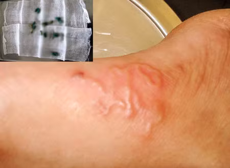 Sán dải cho mà vào gan, lá lách, và sinh ra nhiều ấu trùng rất dễ dẫn tới nhiễm trùng nặng hơn là gây ra tử vong cho con người.