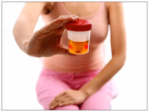 Một số người trong nước tiểu có máu do mắc bệnh tiểu máu. Vì căn bệnh này bất cứ khi nào đi tiểu trong nước tiểu của họ đều có nhưng tế bào máu nhỏ có thể mắt thường không nhìn thấy được.