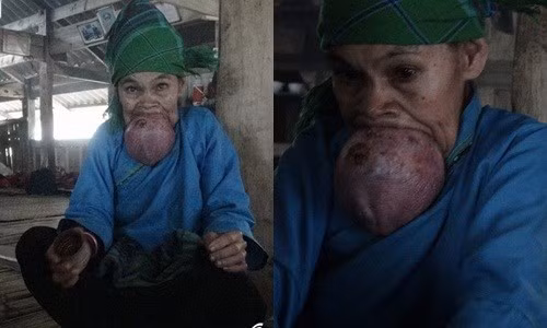 Phau thuat cat bo luoi khong lo cho cu ba o Ha Giang-Hinh-2