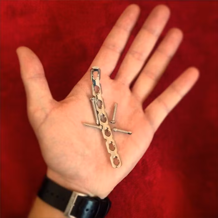 Một năm sau đó các xương bị gẫy đã cơ bản lành lại hoàn toàn, những việc đinh và nẹp kim loại được đóng vào xương trước đó đã được bác sĩ tháo ra.