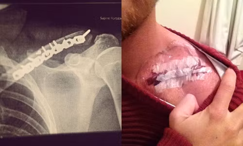 Thông tin về chàng trai bị gãy xương sườn và xương đòn và việc làm không ai ngờ tới của anh chàng được đăng tải trên trang Boredpanda.