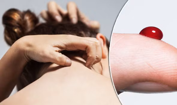  Bệnh mẩn ngứa nổi mề đay khắp người: Đây cũng là căn bệnh nhiều phụ nữ gặp phải.