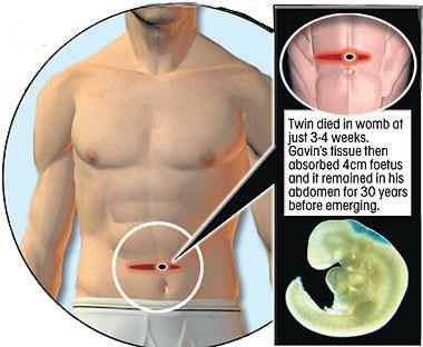 Nguoi dan ong de ra anh em sinh doi qua ron