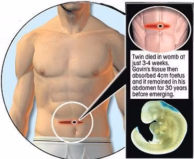 Nguoi dan ong de ra anh em sinh doi qua ron