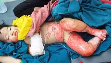 2 me con bi bong nang khi bat bep nau an