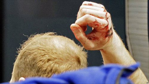 Theo Ria Novosti, điều tra ban đầu cho thấy một kẻ đánh bom tự sát kích khối thuốc có sức công phá của khoảng 5-7 kg thuốc nổ TNT tại sảnh đến quốc tế lúc 16h40 chiều 24/1. Quả bom được cài thêm nhiều mảnh kim loại nhỏ để tăng độ sát thương. Ảnh: Một nạn nhân trong vụ tấn công khủng bố sân bay làm rúng động nước Nga.