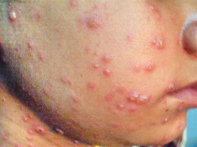 Người mắc phải giời leo gặp rất nhiều phiền toái với những nốt mụn nước phồng rộp trên bề mặt da cho đến khi có lớp sừng bao bọc. Ảnh: benhzona.net.