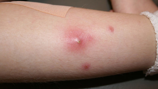 Chữa mụn nhọt: Rau má 50g, lá gấc 50g. Cách dùng: Rửa cả hai thứ thật sạch, giã nhỏ, cho ít muối vào trộn đều, đắp lên chỗ đau rồi băng lại. Ngày thay thuốc hai lần. Đắp đến khi khỏi. Ảnh: suckhoedoisong.vn.