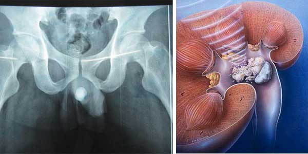 Trị sỏi niệu đạo, sỏi bàng quang, thấp nhiệt hoàng đản, sỏi mật, cảm cúm, ho do phong hàn, kinh nguyệt không đều, thống kinh. Liều dùng 15-30g, dạng thuốc sắc. Ảnh: than.com.vn.