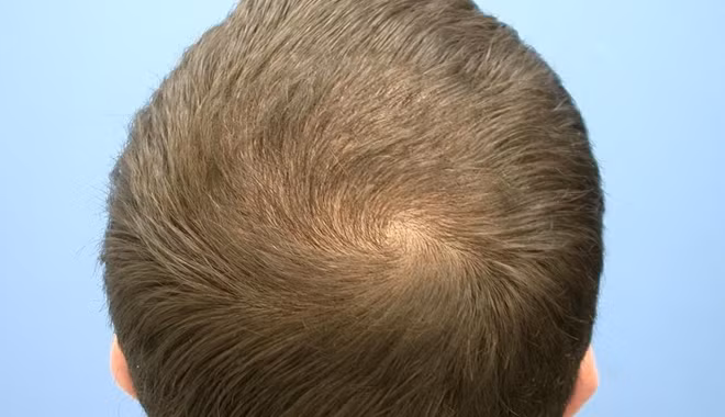 1. Một xoáy tóc: Đây là trường hợp phổ biến nhất. Những bé này lớn lên sẽ trở thành người mạnh mẽ, không dễ khuất phục trước khó khăn. Bé có lập trường, công bằng, làm việc có nguyên tắc, phân minh, chính trực. Ảnh: Bestie.vn.