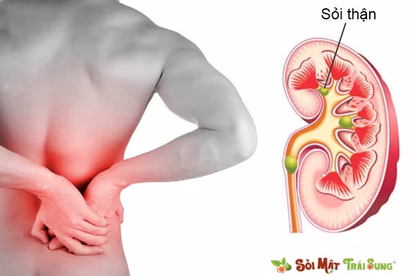 Mướp đắng trị bệnh sỏi thận: Mướp đắng có chứa thành phần có tác dụng trung hoà lượng axit dư thừa dẫn tới căn bệnh sỏi thận. Để có được hiệu quả cao, bạn nên hoà bột mướp đắng cùng nước ấm thành “trà khổ qua” và uống mỗi ngày. Ảnh: soimattraisung.vn. (Thông tin trong bài chỉ mang tính chất tham khảo, trước khi sử dụng bài thuốc, vui lòng hỏi ý kiến bác sĩ).