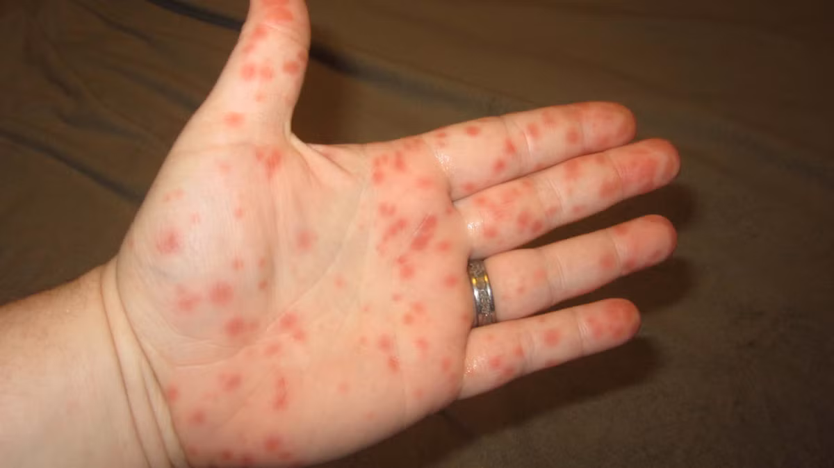 1. Chữa chứng sốt xuất huyết (kể cả các xuất huyết dưới da): Lá huyết dụ tươi 30g, trắc bá sao đen 20g, cỏ nhọ nồi 20g. Sắc uống ngày 1 thang, chia 2 – 3 lần. Ảnh: hellobacsi.com.