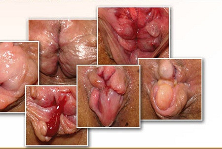 5. Chữa bạch đới, khí hư, lỵ, rong huyết, viêm dạ dày, viêm ruột, trĩ nội, hậu môn lở loét ra máu: Huyết dụ tươi 40g, lá sống đời (lá bỏng) 20g, xích đồng nam 20g, sắc uống ngày 1 thang, chia 2 – 3 lần. Ảnh: antrinam.com.