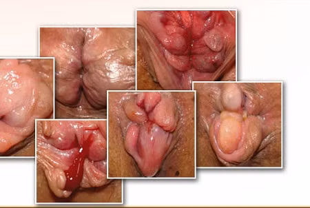 5. Chữa bạch đới, khí hư, lỵ, rong huyết, viêm dạ dày, viêm ruột, trĩ nội, hậu môn lở loét ra máu: Huyết dụ tươi 40g, lá sống đời (lá bỏng) 20g, xích đồng nam 20g, sắc uống ngày 1 thang, chia 2 – 3 lần. Ảnh: antrinam.com.