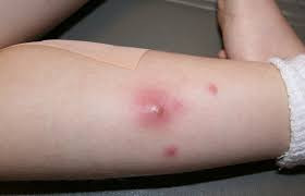 Mụn nhọt mới phát: Búp ổi non và lá đào lượng vừa đủ, rửa sạch, giã nát rồi đắp lên vùng tổn thương. Ảnh: cachdieutrimuntrungca.com.