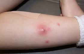 Mụn nhọt mới phát: Búp ổi non và lá đào lượng vừa đủ, rửa sạch, giã nát rồi đắp lên vùng tổn thương. Ảnh: cachdieutrimuntrungca.com.