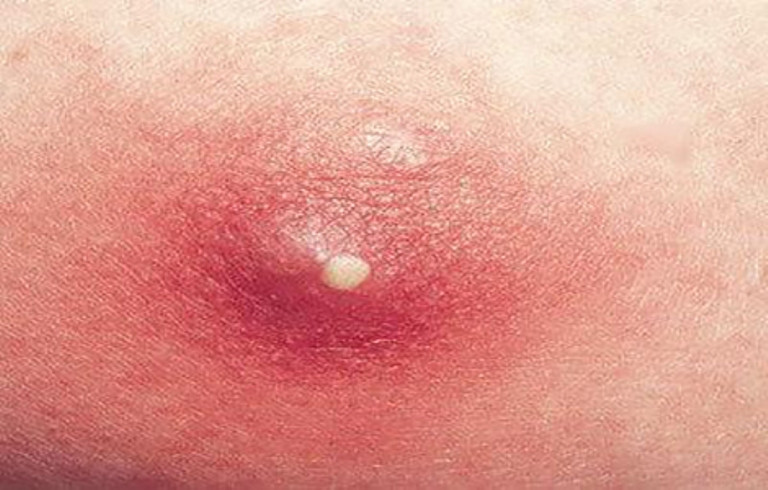 1. Mướp đắng trộn rượu chữa mụn nhọt đau nhức: Lá mướp đắng một nắm, sắc uống cùng một chén rượu, hoặc phơi khô tán bột uống mỗi lần 12 gr với rượu. Ngoài giã lá tươi chưng nóng đắp. Ảnh: zabolevaniyakozhi.ru.