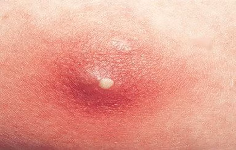 1. Mướp đắng trộn rượu chữa mụn nhọt đau nhức: Lá mướp đắng một nắm, sắc uống cùng một chén rượu, hoặc phơi khô tán bột uống mỗi lần 12 gr với rượu. Ngoài giã lá tươi chưng nóng đắp. Ảnh: zabolevaniyakozhi.ru.