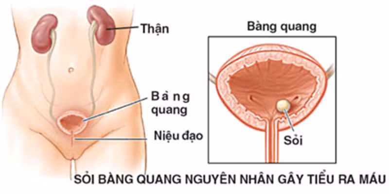 Chữa đái ra sỏi, đái ra máu và đái buốt: Râu mèo 40g, thài lài trắng 30g, Sắc lấy nước, mỗi lần hòa thêm 6g bột hoạt thạch uống trong ngày, chia làm 3 lần. Uống liền 5 – 7 ngày. Ảnh: ViCare.vn.