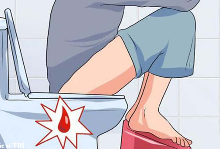Một dấu hiệu bệnh trĩ nên lưu ý khác nữa đó là tình trạng táo bón hoặc cảm giác đi đại tiện không hết. Ảnh: ihs.